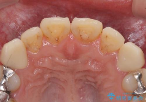 矯正治療後のセラミッククラウンの治療後