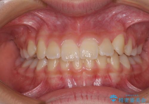 埋もれた犬歯を引っ張り出す 小学生のⅠ期治療の治療後