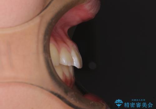 埋もれた犬歯を引っ張り出す 小学生のⅠ期治療の治療後