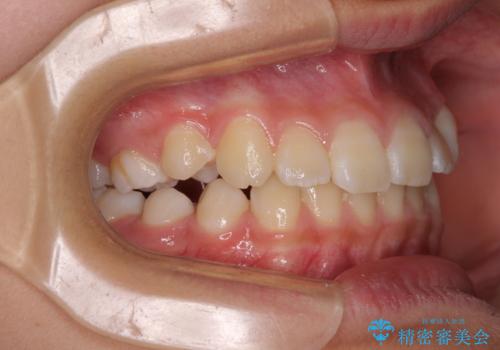 埋もれた犬歯を引っ張り出す 小学生のⅠ期治療の治療後