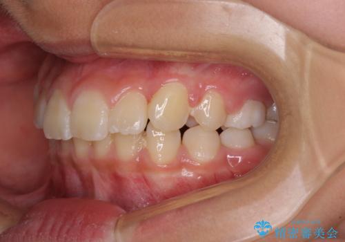 埋もれた犬歯を引っ張り出す　小学生のⅠ期治療の治療後
