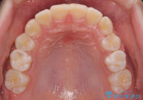埋もれた犬歯を引っ張り出す 小学生のⅠ期治療の治療後