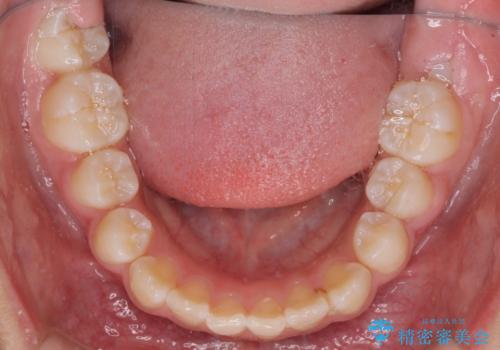 埋もれた犬歯を引っ張り出す 小学生のⅠ期治療の治療後