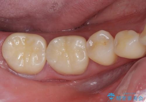 奥歯の壊れたり汚れたりしたクラウン　オールセラミッククラウンによる審美歯科治療　の症例 治療後