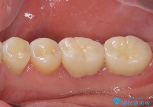 奥歯の壊れたり汚れたりしたクラウン オールセラミッククラウンによる審美歯科治療 の治療後