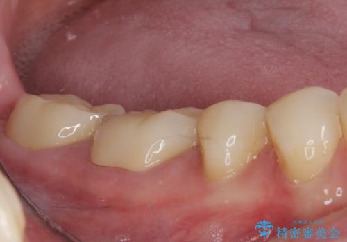 奥歯の壊れたり汚れたりしたクラウン　オールセラミッククラウンによる審美歯科治療　の治療後