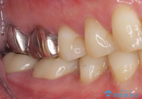 奥歯の壊れたり汚れたりしたクラウン オールセラミッククラウンによる審美歯科治療 の治療後