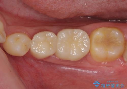 深い虫歯で歯茎が腫れる　部分矯正を用いたむし歯治療