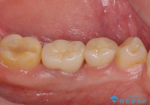 深い虫歯で歯茎が腫れる 部分矯正を用いたむし歯治療の治療後