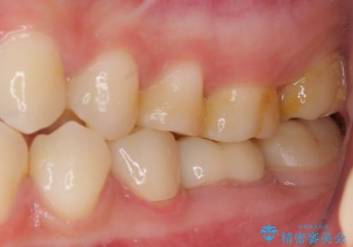 深い虫歯で歯茎が腫れる　部分矯正を用いたむし歯治療の治療後
