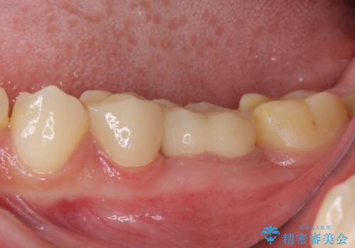 深い虫歯で歯茎が腫れる　部分矯正を用いたむし歯治療の症例 治療後