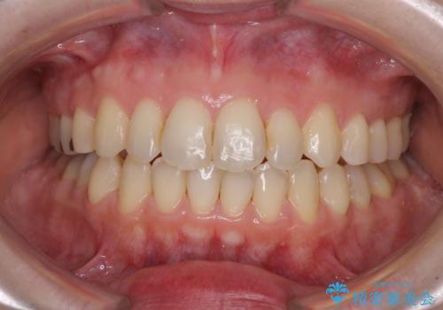 前歯のデコボコを改善　目立たないワイヤー矯正の症例 治療後