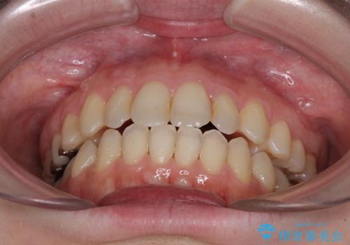 前歯のデコボコを改善　目立たないワイヤー矯正の治療後