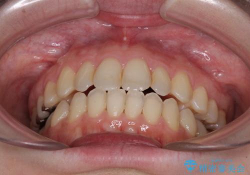 前歯のデコボコを改善 目立たないワイヤー矯正の治療後