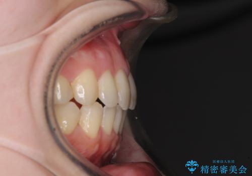 前歯のデコボコを改善 目立たないワイヤー矯正の治療後