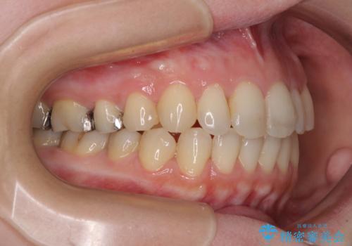 前歯のデコボコを改善 目立たないワイヤー矯正の治療後