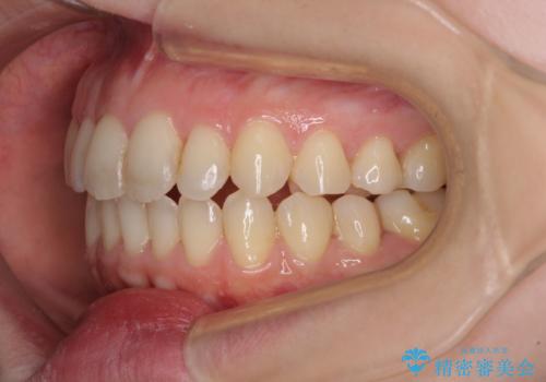 前歯のデコボコを改善 目立たないワイヤー矯正の治療後