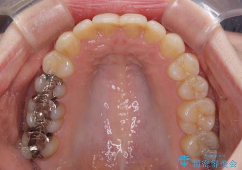 前歯のデコボコを改善 目立たないワイヤー矯正の治療後