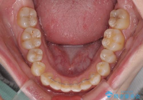 前歯のデコボコを改善　目立たないワイヤー矯正の治療後