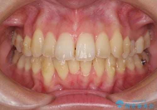 インビザラインでスッキリとした口元にの治療中