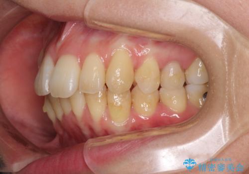 インビザラインでスッキリとした口元にの治療中