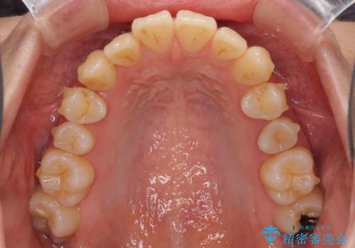 インビザラインでスッキリとした口元にの治療中