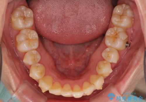 インビザラインでスッキリとした口元にの治療中