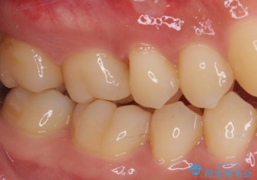 フロスが引っかかる セラミックインレーによるむし歯治療の治療後