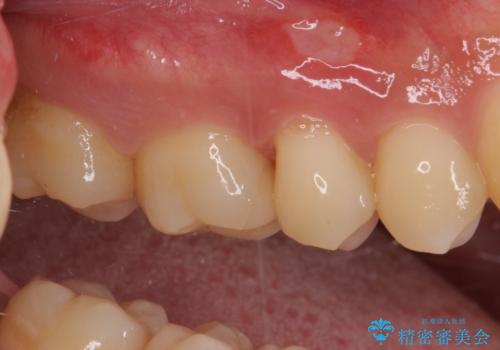 フロスが引っかかる セラミックインレーによるむし歯治療の治療後