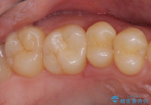 フロスが引っかかる セラミックインレーによるむし歯治療の治療後