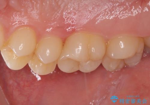 フロスが引っかかる セラミックインレーによるむし歯治療の治療後