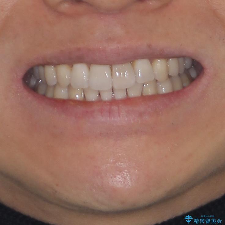 前歯のデコボコを治したい インビザラインによる矯正治療の治療後(顔貌)