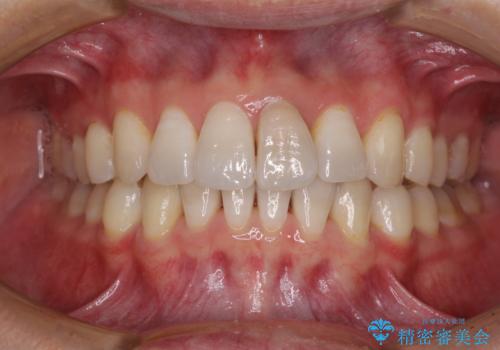 前歯のデコボコを治したい インビザラインによる矯正治療