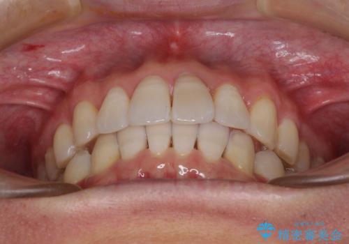 前歯のデコボコを治したい インビザラインによる矯正治療の治療後