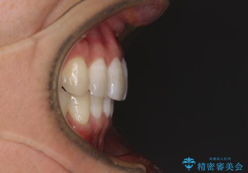 前歯のデコボコを治したい インビザラインによる矯正治療の治療後