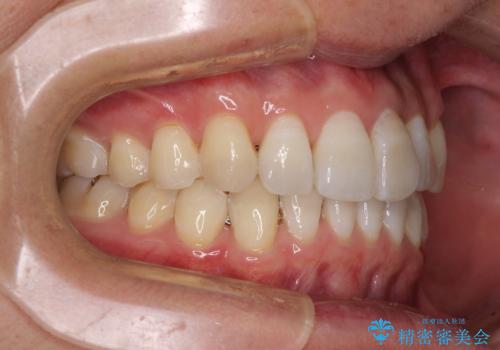 前歯のデコボコを治したい インビザラインによる矯正治療の治療後