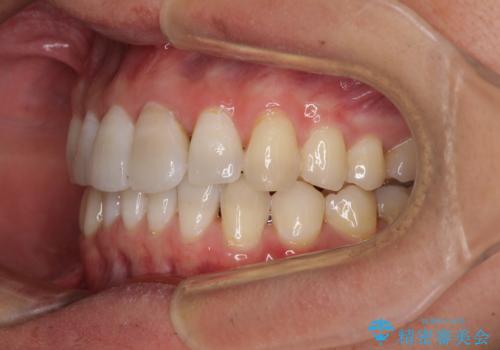 前歯のデコボコを治したい インビザラインによる矯正治療の治療後