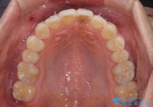 前歯のデコボコを治したい インビザラインによる矯正治療の治療後