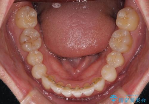前歯のデコボコを治したい インビザラインによる矯正治療の治療後