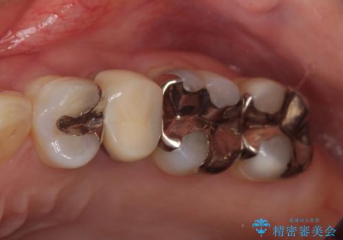 オールセラミッククラウン 銀歯を白くの治療前