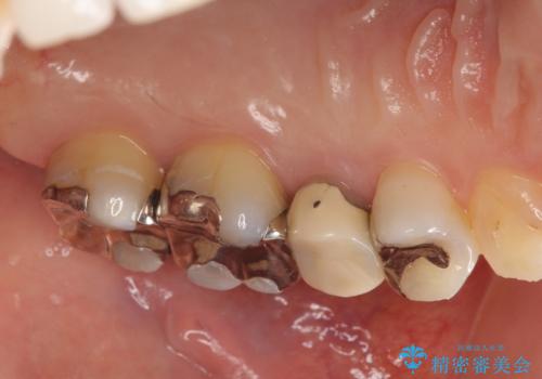 オールセラミッククラウン 銀歯を白くの治療前