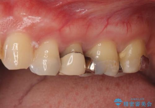 オールセラミッククラウン　銀歯を白くの症例 治療前