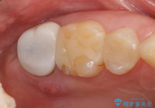 オールセラミッククラウン 虫歯治療・再根管治療の治療前
