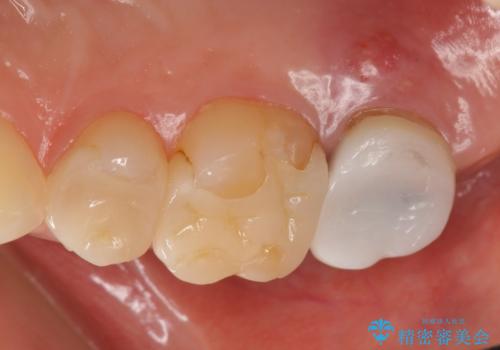 オールセラミッククラウン 虫歯治療・再根管治療の治療前