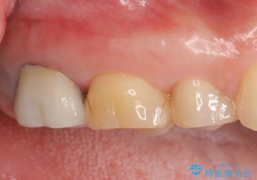 オールセラミッククラウン 虫歯治療・再根管治療の症例 治療前