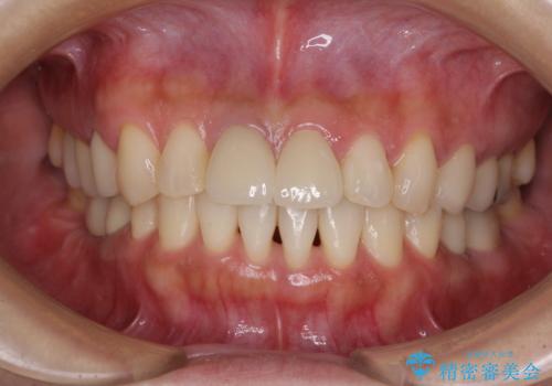 気になる部分を全て治療　総合歯科治療で口腔内環境改善の症例 治療後