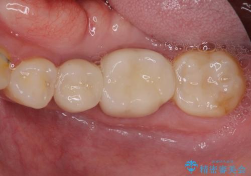 気になる部分を全て治療　総合歯科治療で口腔内環境改善の治療後