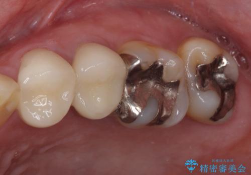 気になる部分を全て治療　総合歯科治療で口腔内環境改善の治療後