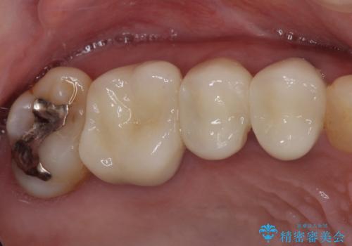 気になる部分を全て治療 総合歯科治療で口腔内環境改善の治療後