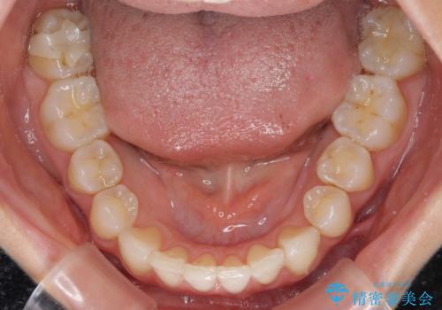 上顎前歯が2本欠損 インビザラインによる叢生の解消の治療後